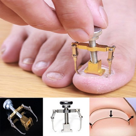 নখের কোনা সোজা করার অত্যাধুনিক যন্ত্র ( NAIL REPAIR